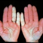 natural remedies for raynaud's Natural remedy for raynaud's