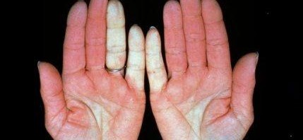 natural remedies for raynaud's Natural remedy for raynaud's