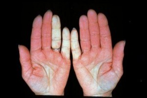 Natural remedy for raynaud's