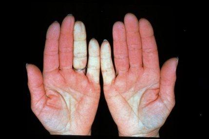 Natural remedy for raynaud's